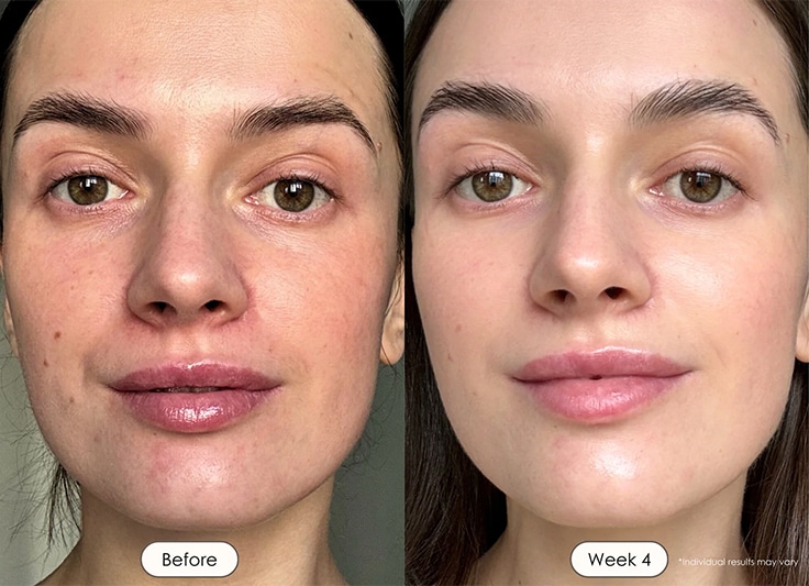 RLT-BeforeAfter-horz